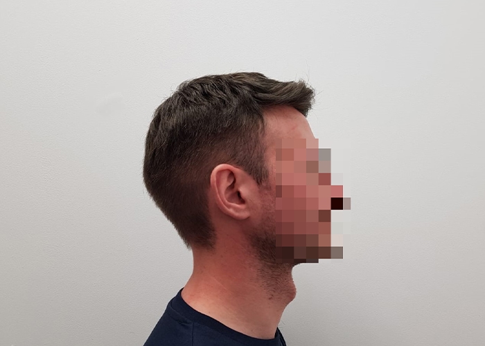 Side of Hair System cut at Hair4all Bristol